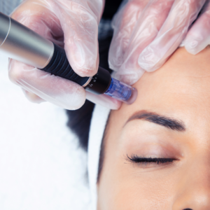 Dermapen – Inteligentna regeneracja, którą widać!
